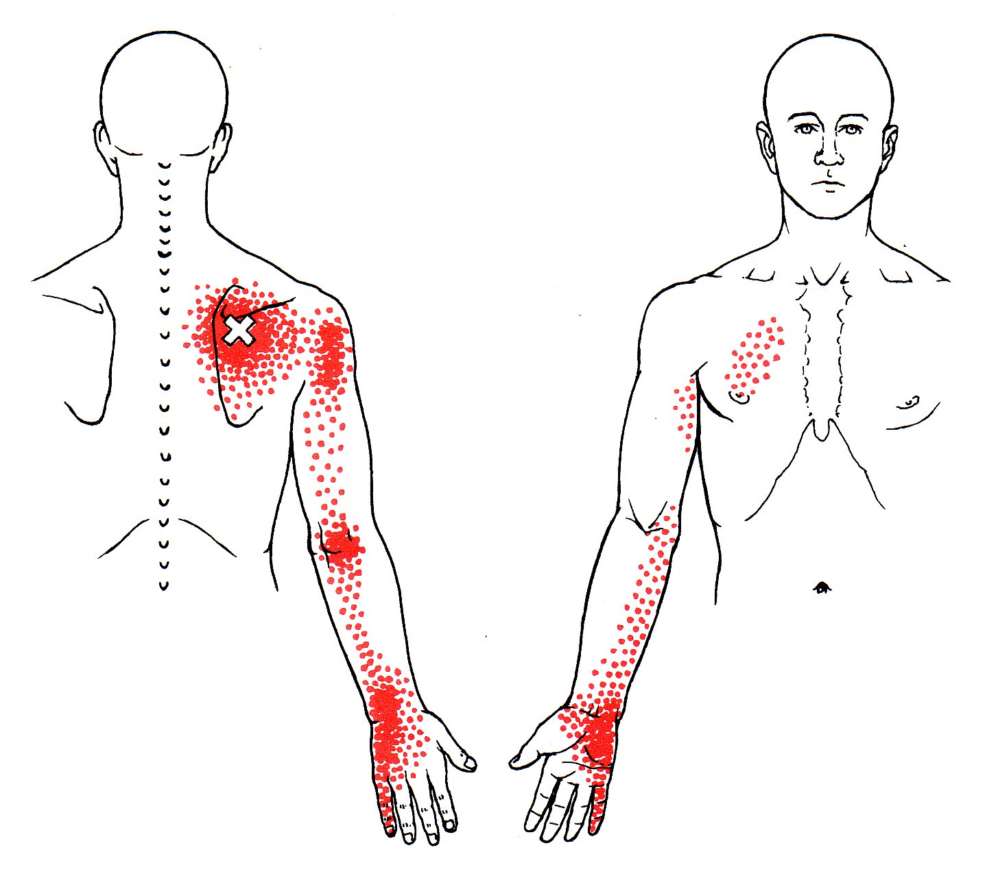 Serratus Posterior Superior The Trigger Point And Referred Pain Guide